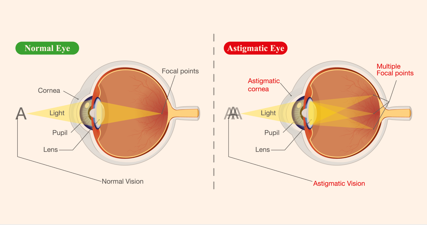 person with astigmatism